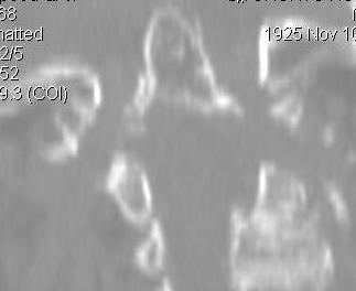 Superior Migration Ondontoid CT Coronal